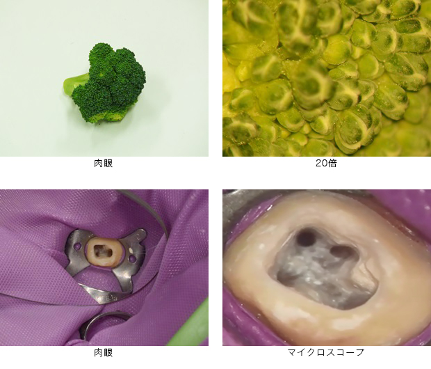 同じ歯を肉眼で見た場合とマイクロスコープで見た場合の，見え方の違いを比較した図