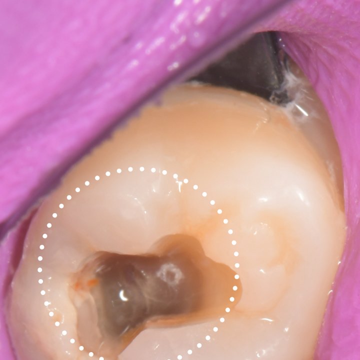 ラバーダムで隔離した状態で，深くまで進んだ虫歯の広がりを確認しているところ