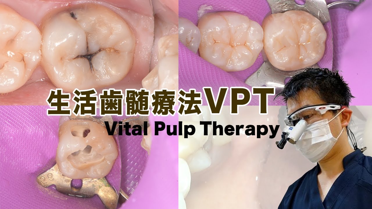 動画のサムネイル：ラバーダムを装着した大臼歯と，ルーペを着けて処置にあたる院長。VPT（歯髄温存療法）の実際の治療動画